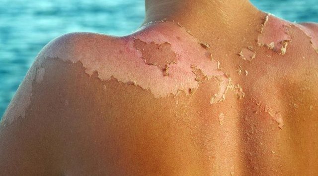 Bí quyết chăm sóc da sau khi bị cháy nắng